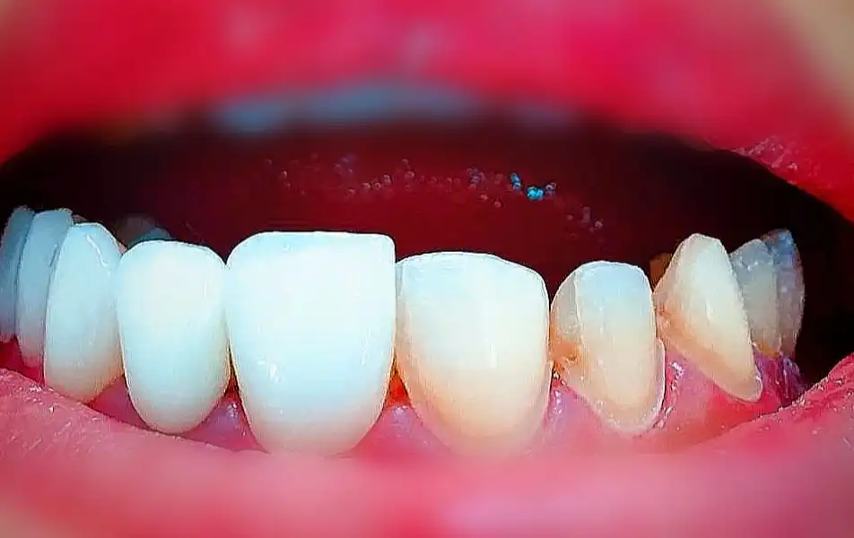 تجميل الاسنان بـ العدسات اللاصقة