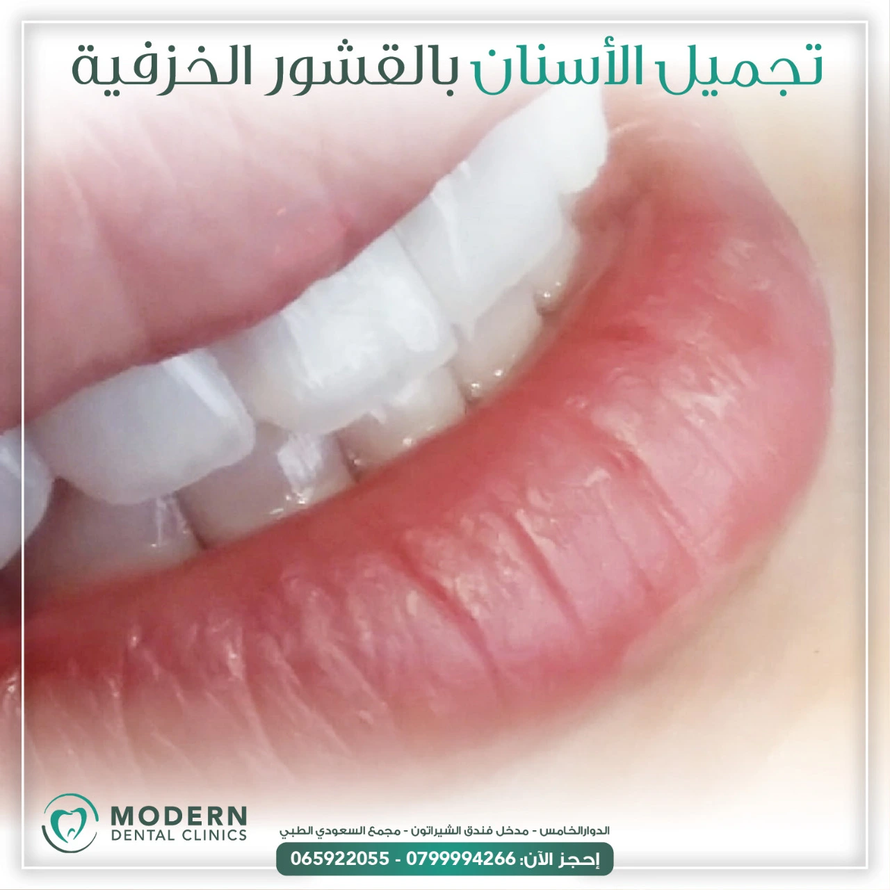 أسرار الحفاظ على ابتسامة هوليود: الروتين المثالي للعناية بهذه الابتسامة!