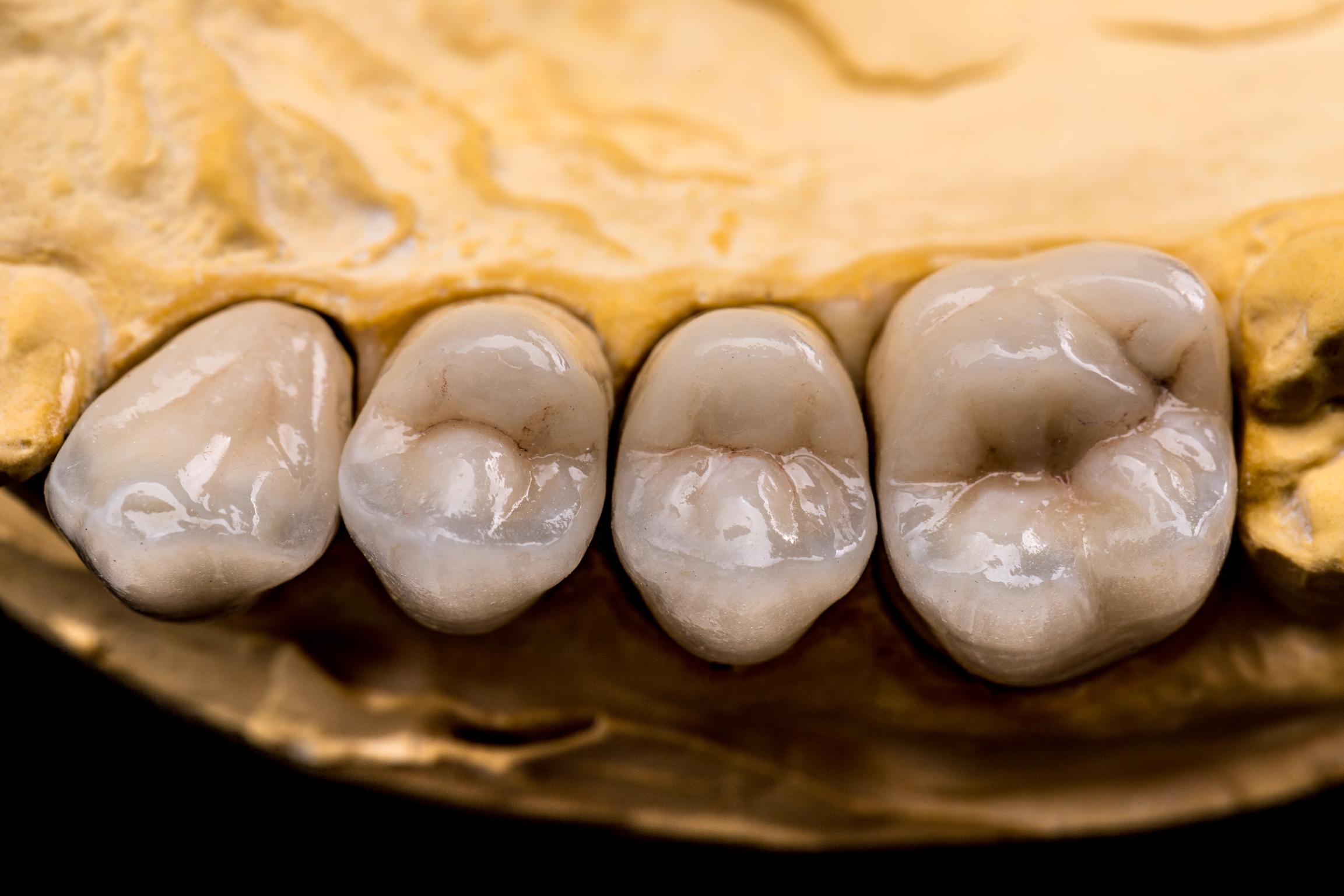 dental-crowns-on-a-dental-model-2026-03-19-08-12-20-utc (1).jpg